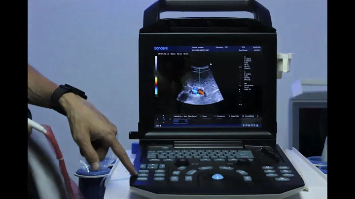 Ultrasonido Zoncare M5 Color Doppler